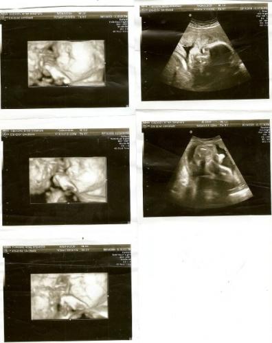 ultrasounds of Brian